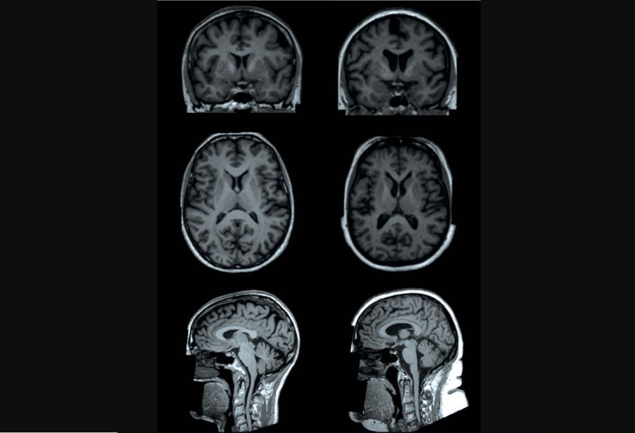 sağ lobuyla sol lobu arasında sinirsel iletişimi sağlayan corpus callosum bölgesinde