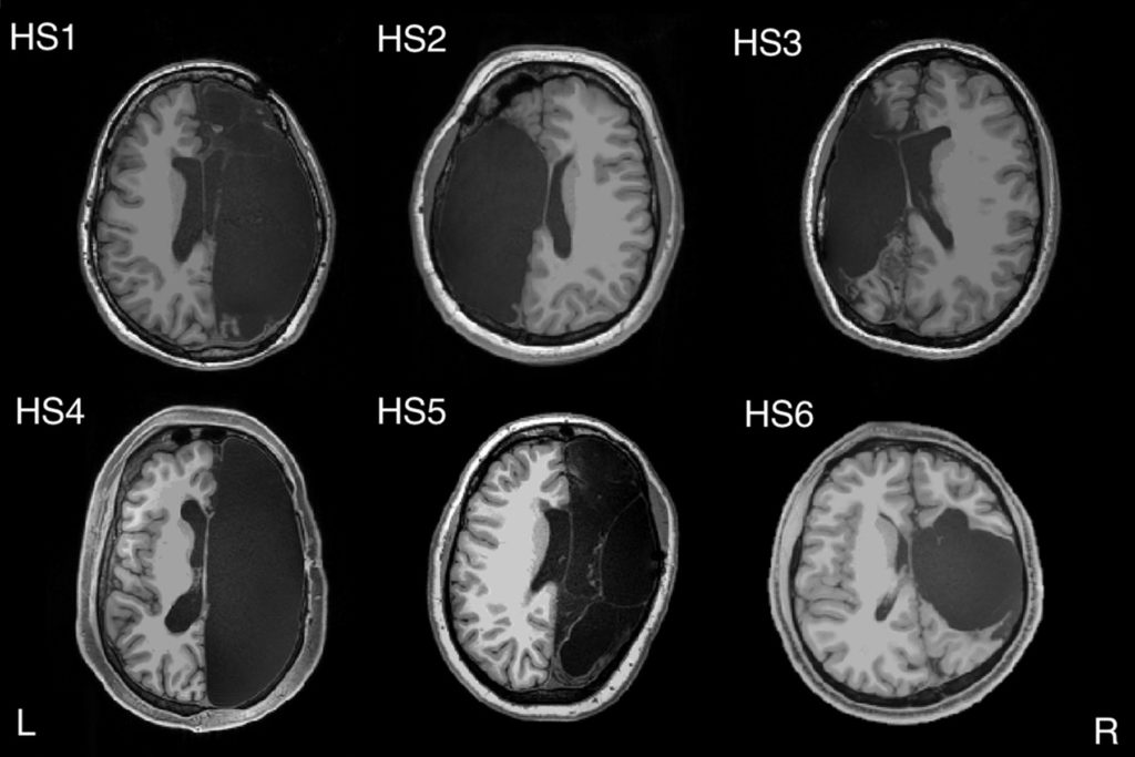 Araştırmacılar katılımcıların beyinlerinde MRI taramaları yaptı ve sonuçları sağlıklı insanlara ait sonuçlarla karşılaştırdı. 